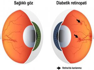 DİYABET HASTALARINA GÖZ KONTROLÜ ŞART