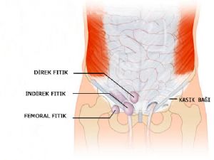 Kasık Fıtığına Dikkat
